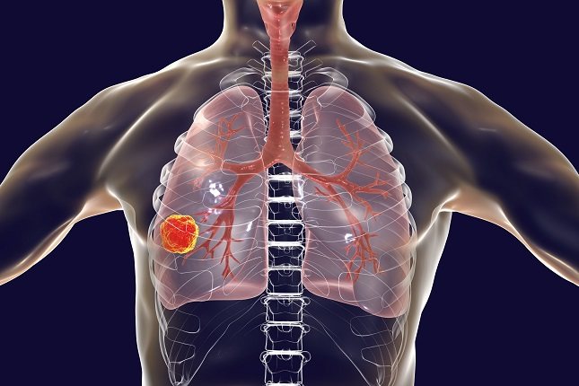 Es importante darse cuenta de que el cáncer no es una enfermedad única