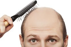 Minoxidil contra la alopecia, Â¿es efectivo?