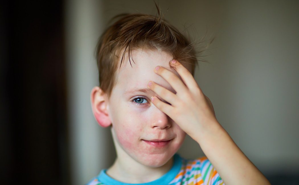 Cómo saber si tienes dermatitis atópica