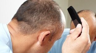 Diferentes tipos de alopecia