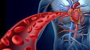 Qué es una angioplastia y cuándo se realiza