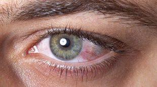 Cómo evitar la conjuntivitis en verano