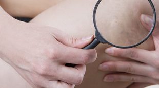 Qué es la flebitis y la tromboflebitis