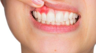 Qué es la melanosis gingival o encías oscuras