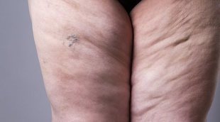 Lipedema: el síndrome de la grasa dolorosa