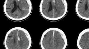 Qué es el hematoma subdural