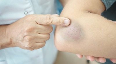 Consejos fáciles para eliminar los hematomas