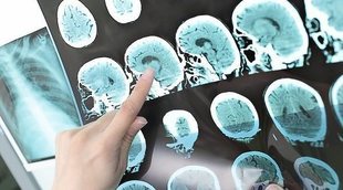 Tratamiento para un tumor cerebral