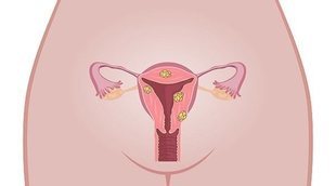 ¿Qué son los fibromas uterinos?