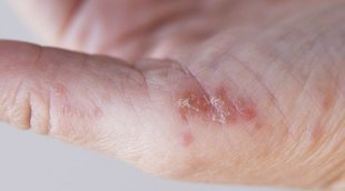 Psoriasis pustulosa: qué debes saber