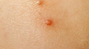 En qué consiste la enfermedad del molusco contagioso