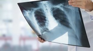 Tipos de infecciones pulmonares