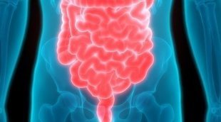 Síntomas de un brote de diverticulitis